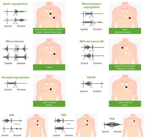 Mitral Stenosis | Concise Medical Knowledge