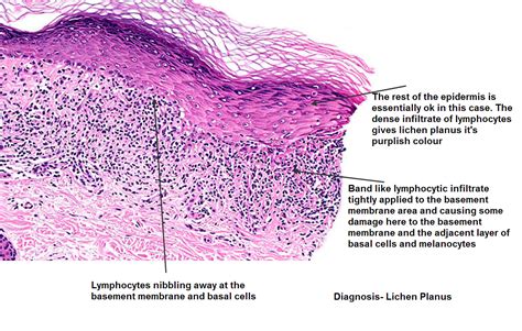 Lichen Planus Histology Images | Images and Photos finder