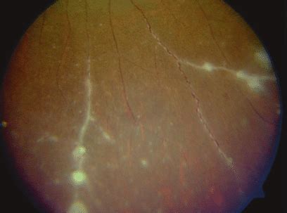 Fundus picture of the patient showing vitritis and exudative retinal ...