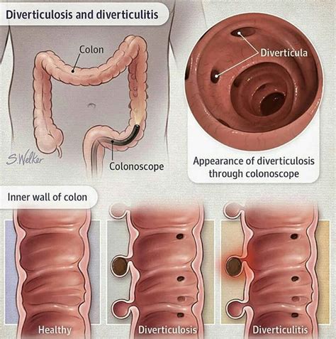 Diverticulosis & Diverticulitis | Gastroenterology, Diverticulitis, Medical anatomy