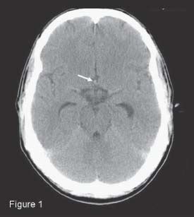 31 Unruptured Anterior Communicating Artery Aneurysm | Neupsy Key