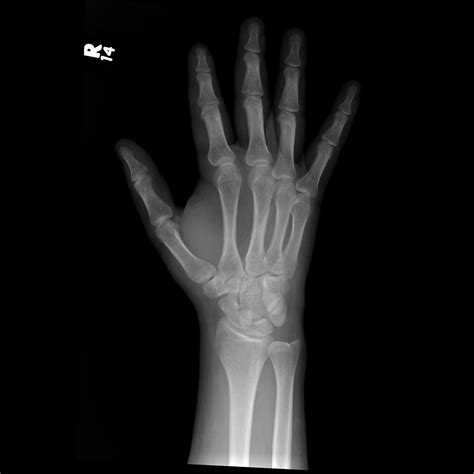 Types Of Wrist Fractures - Fracture Treatment