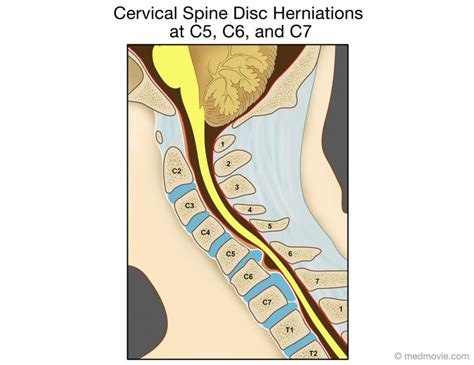 Cervical Spine Disc Herniations at C5, C6, and C7 – Medmovie.com