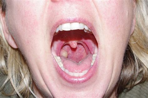 Cancerous tonsil cyst | Meshotelioma Cancer | Pinterest