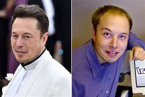 Elon Musk Hair Transplant - Before and After - HowChimp