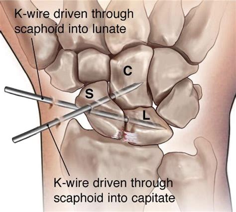 Arthroscopic Anatomy Of The Wrist With Scapholunate Ligament Injury | The Best Porn Website