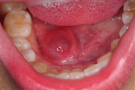 ranula marsupialization floor of mouth kazemi oral surgery bethesda MD 1 | ranula ...