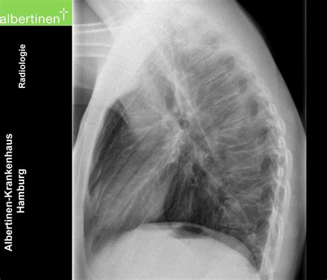 X-ray of the thorax, lateral: Normal finding - DocCheck