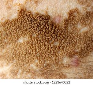 526 Hyperkeratosis Images, Stock Photos & Vectors | Shutterstock