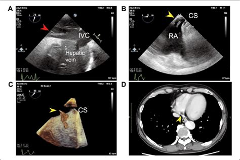 A) Intraoperative transesophageal echocardiography (TEE) showing an ...