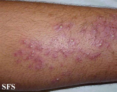 List of Itchy Rashes | HubPages