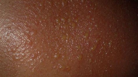 Sunburn Blisters: Symptoms, Treatments, and Complications