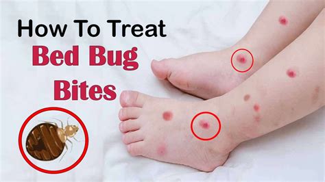 How To Treat Bed Bug Bites On Babies | Images and Photos finder