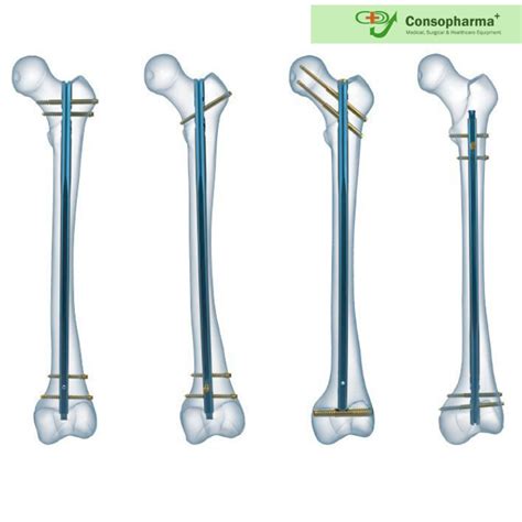 A Brief Overview of Intramedullary Nailing - CONSOPHARMA+