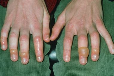 Chilblains (perniosis) - symptoms and treatment | healthdirect