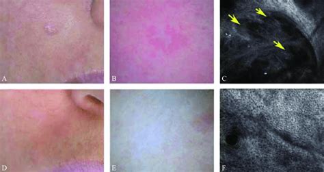 -Before treatment. A) Clinical image of a nodular BCC of the cheek; B ...