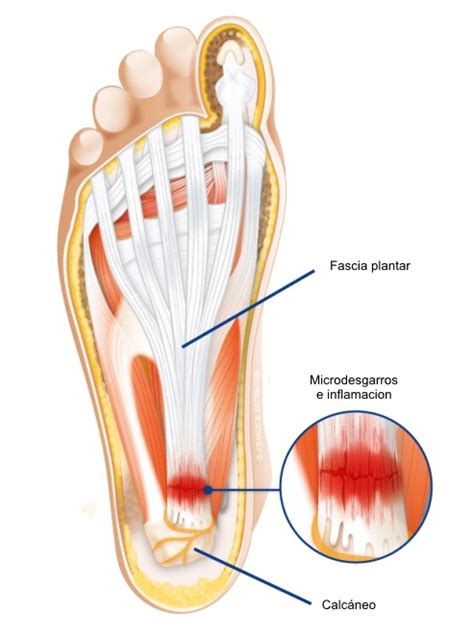 aumento toda la vida estético fascia plantar anatomía Para aumentar Seis Disfrazado