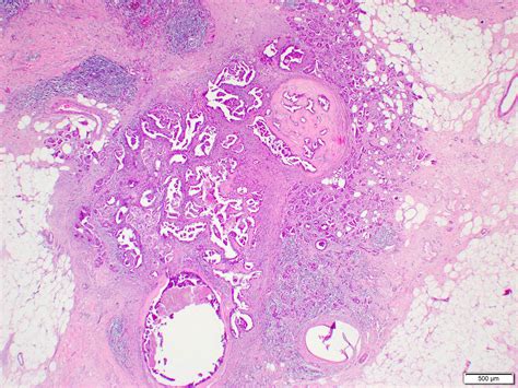 Papillary Carcinoma