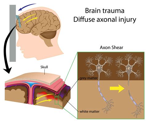 Diffuse Brain Injury – Scottish Acquired Brain Injury Network