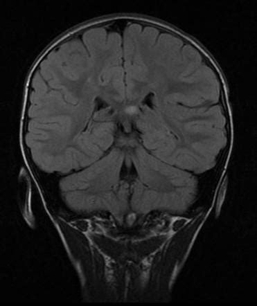 Corpus callosum hyperintensity (mnemonic) | Radiology Reference Article | Radiopaedia.org