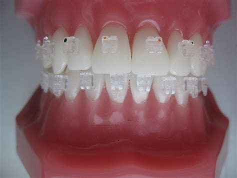 Fixed orthodontic appliances - Specialized dental studio “Aponia”, Belgrade, Serbia