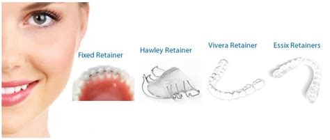 Retainer for Braces | Cost of Retainers | Clear, Hawley, Vivera