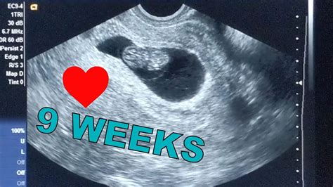 9 Weeks Ultrasound Gender - EARLY GENDER PREDICTION ~ RAMZI METHOD ~ 7 WEEKS PREGNANT ... : Yes ...