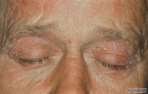 psoriasis eyelid - pictures, photos