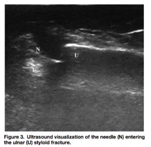 emDOCs.net – Emergency Medicine EducationUltrasound-Guided Hematoma Block - emDOCs.net ...