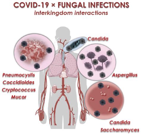 Fungal genera co-infecting patients with COVID-19 described in the ...