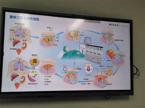 Cryoablation Operation on Cancer Patients