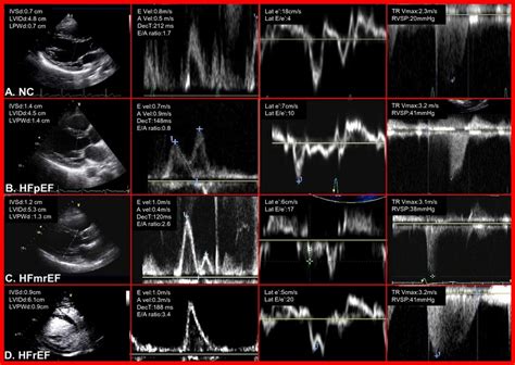 Echocardiogram Of Heart Failure