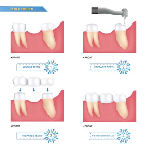 Dental Bridges - Power Smile Dental Centre South Surrey BC