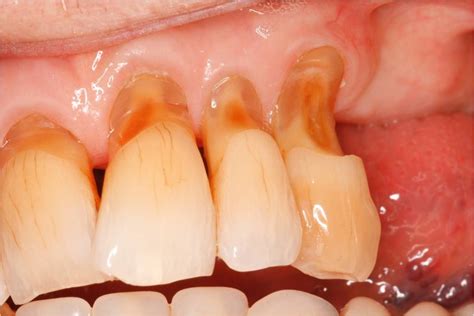 Different types of tooth surface loss. - Mark Hill (Dental Surgeon)