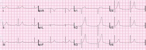 Dr. Smith's ECG Blog: Anterior ST elevation with large broad T-wave: what is the diagnosis?