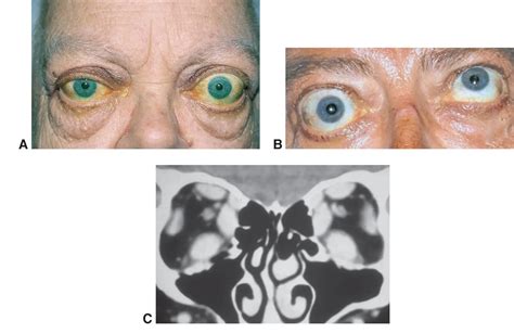 Graves disease - American Academy of Ophthalmology