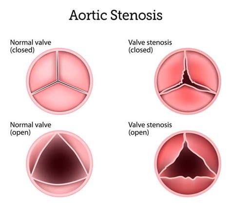 Life Expectancy & Heart Valve Disease: What Should Patients Know?