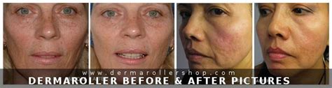 Derma Roller Before & After Pictures|Acne Scars, Stretch marks etc