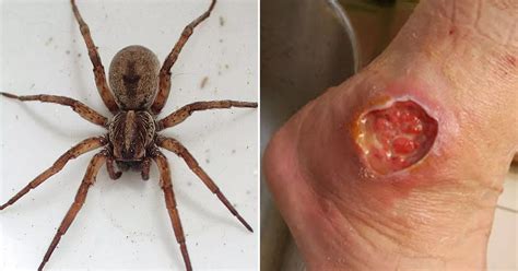 The worst spider bite pictures including the Brown Recluse and Black Widow - Mirror Online