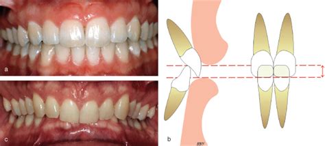 23 Deep overbite malocclusion | Pocket Dentistry