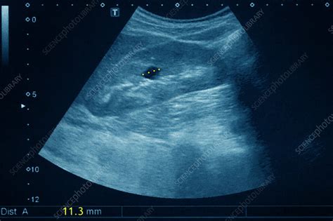 Kidney cyst, ultrasound - Stock Image - C026/8795 - Science Photo Library