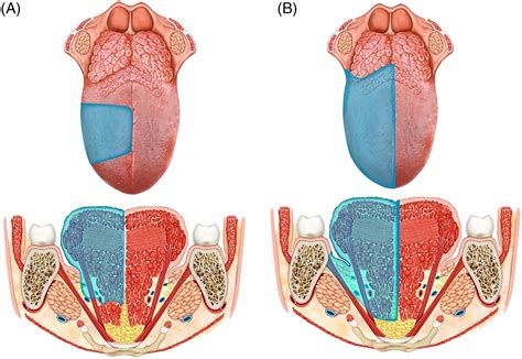 Classification Of GLOSSECTOMIES: Proposal For Tongue Cancer, 57% OFF