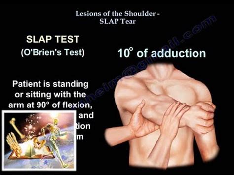 Lesions Of The Shoulder SLAP Tear - Everything You Need To Know - Dr. Nabil Ebraheim - YouTube