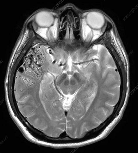 Temporal Lobe AVM on MRI - Stock Image - C027/1586 - Science Photo Library