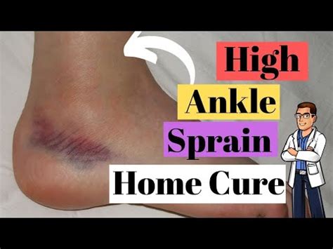 High Ankle Sprain Recovery Time: *The Best Treatment Guide!*