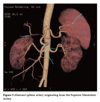 Aberrant Splenic Artery: Case Report of Splenic Artery originating from Superior Mesenteric ...