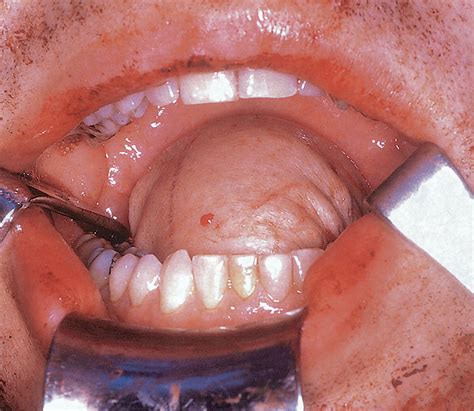 The Anterolateral Thigh Flap | Otolaryngology | JAMA Otolaryngology–Head & Neck Surgery | The ...