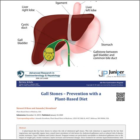 Gallstones – prevention with a plant-based diet – Plant-Based Diets in Medicine