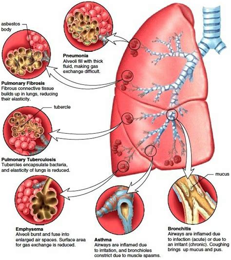 Medical and Health Science: The most common lung diseases