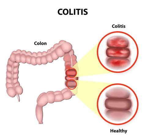 Ulcerative Colitis, Crohn's Disease | Rose Wellness